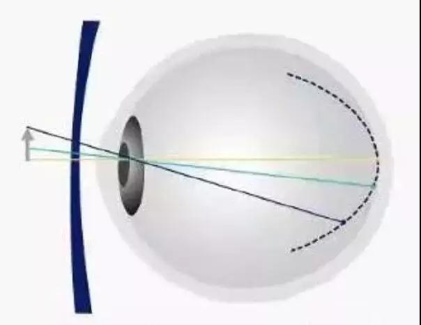 六大专科 医学验光配镜 科普       与普通镜框眼镜"远视性离焦"原理